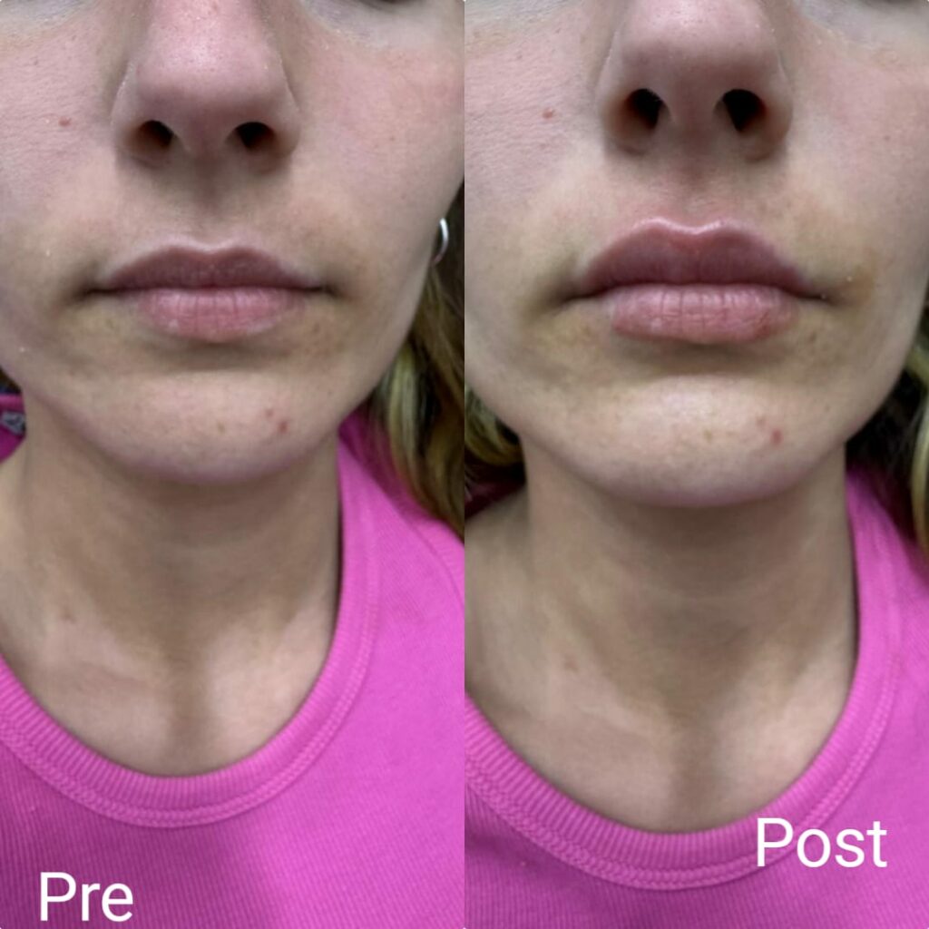 تكبير الشفايف الصغيرة بالفيلر